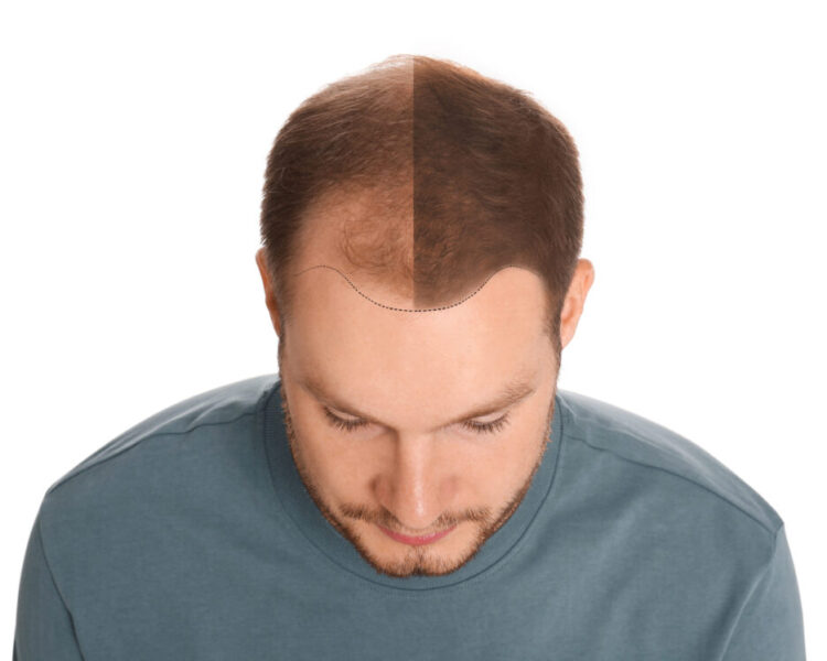 man with hair loss. before and after hair transplant