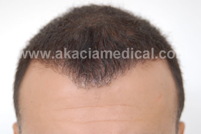 //www.akaciamedical.com/wp-content/uploads/2023/12/P3500_front_efter-6-manader_www.akaciamedical.com_.jpg