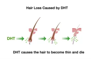 Picture that shows hairloss cause by DHT